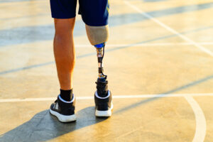 Amputated right leg below the knee with a prosthetic leg and shoe at the bottom