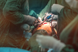 Surgeons with green scrubs on using a drill on a patient amputating a limb