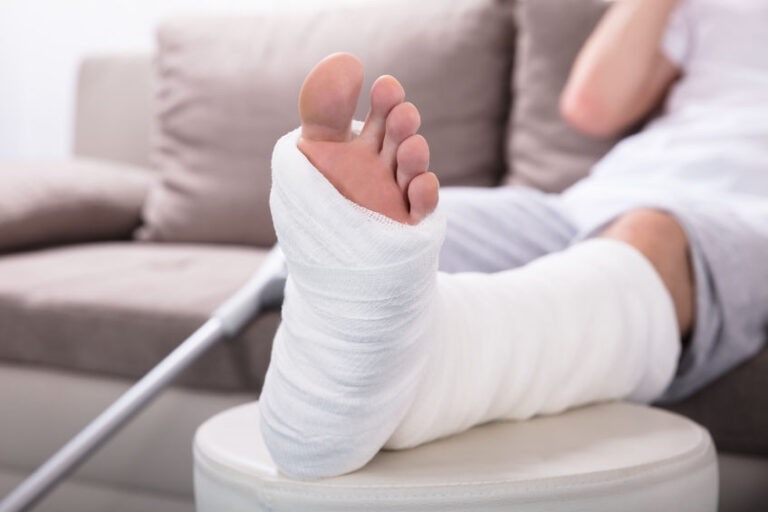 How Much Compensation For A Broken Leg? Case Study And Guide On Broken
