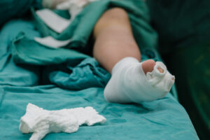 A patient experiencing pressure sore negligence after leg amputation surgery.