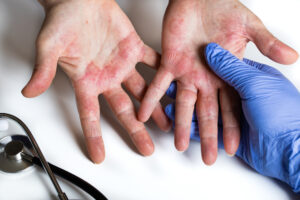A person displays visible symptoms of an allergic reaction.