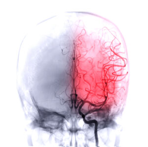 A graphic highlights one side of the brain in red